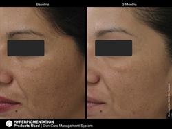 pichyperpigmentation1