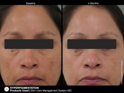 pichyperpigmentation3