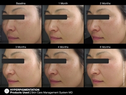 pichyperpigmentation7