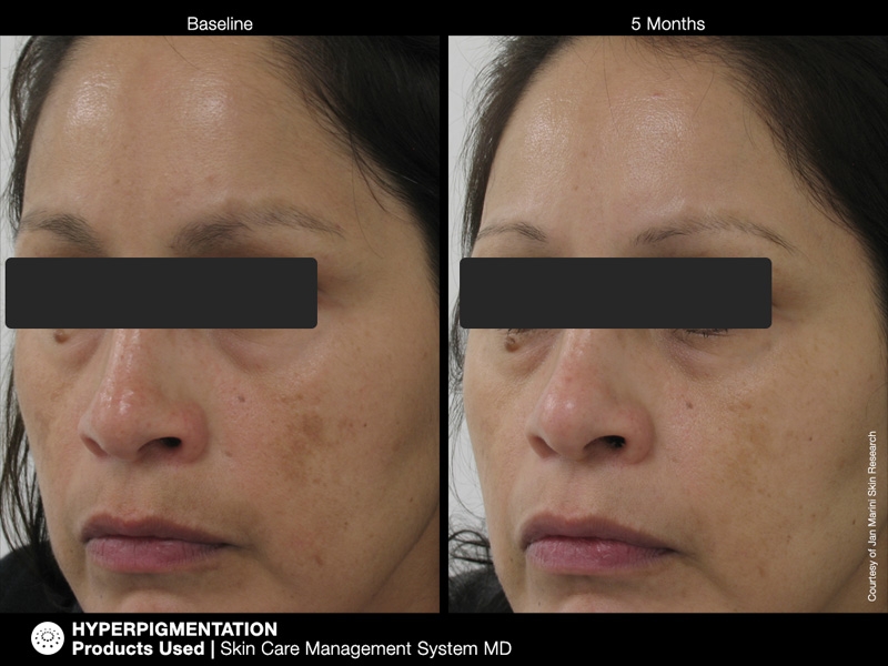 pichyperpigmentation4