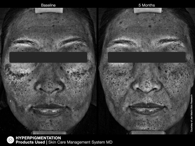 pichyperpigmentation8